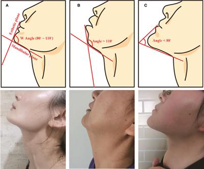 Comparison of Different Mandibular Jawlines Classifications on Transoral Endoscopic Thyroidectomy for Papillary Thyroid Carcinoma: Experiences of 690 Cases